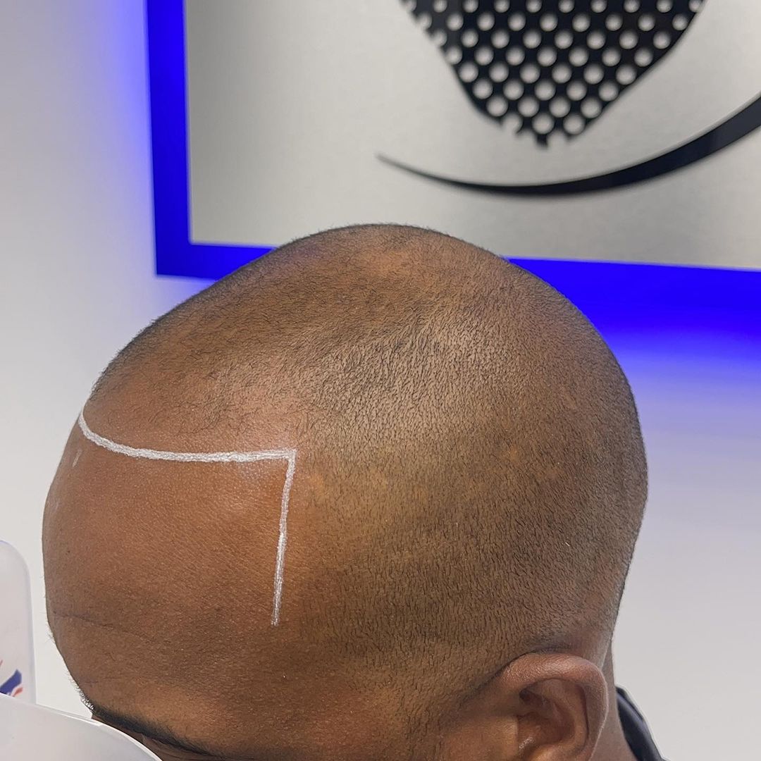 Mr Cutz SMP | Scalp Micropigmentation