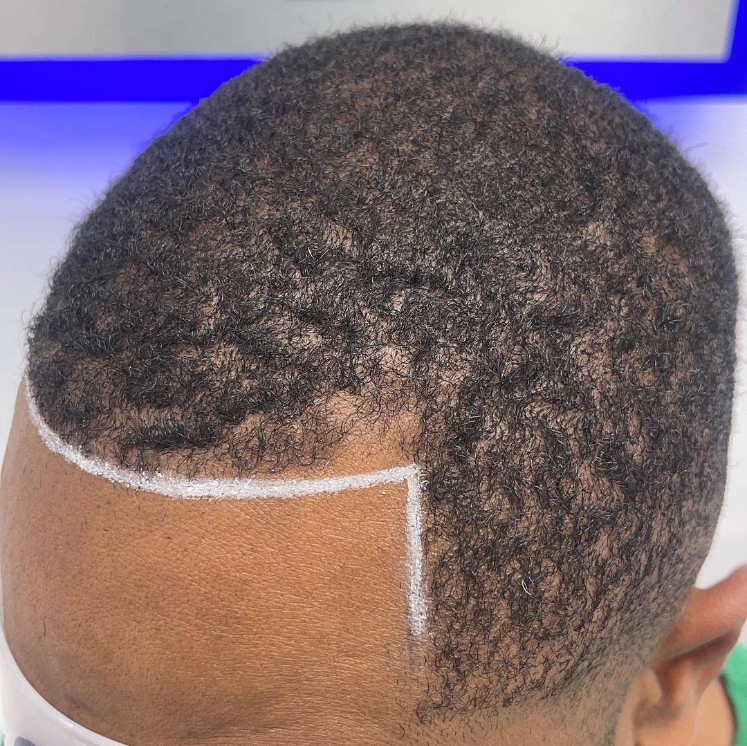 Mr Cutz SMP | Scalp Micropigmentation